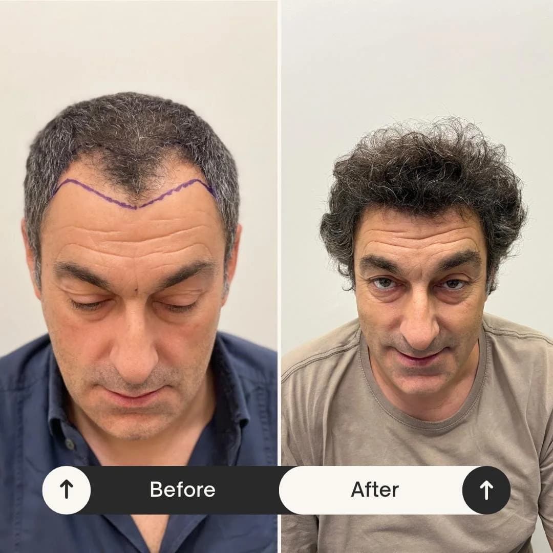Hair Transplant UK: Leading the Way in Modern Hair Restoration