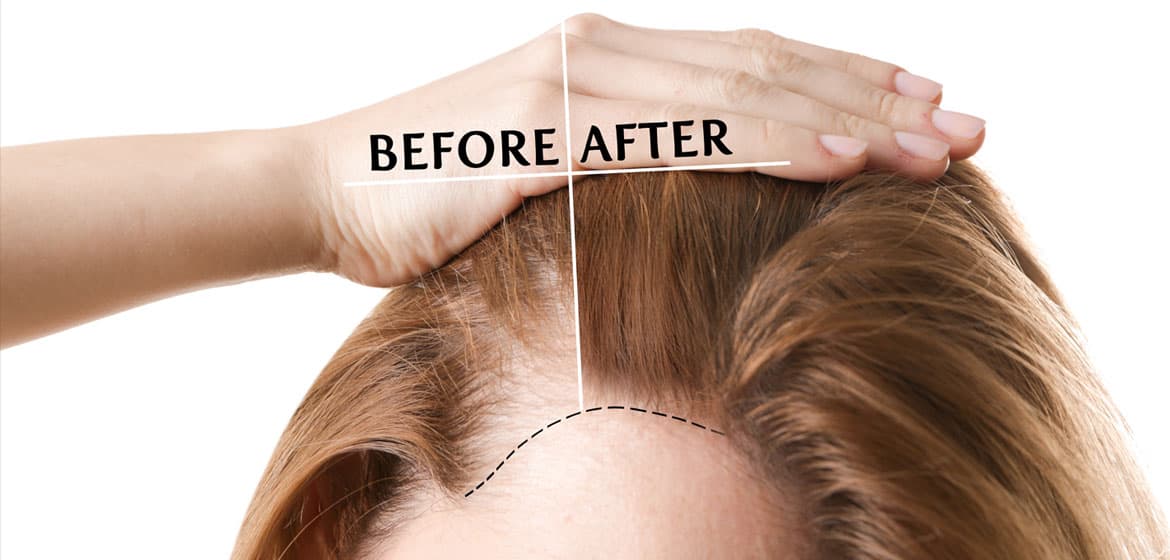Hair Transplant Istanbul: Get the Look You’ve Always Wanted