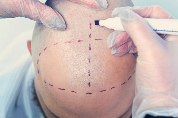 How Much Is Hair Transplant: Full Price Breakdown