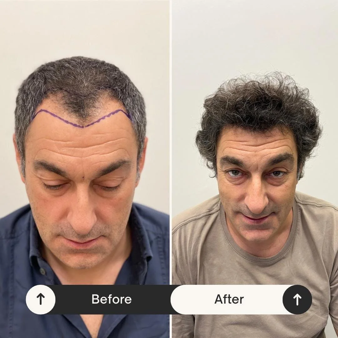 Hair Transplant UK: Leading the Way in Modern Hair Restoration